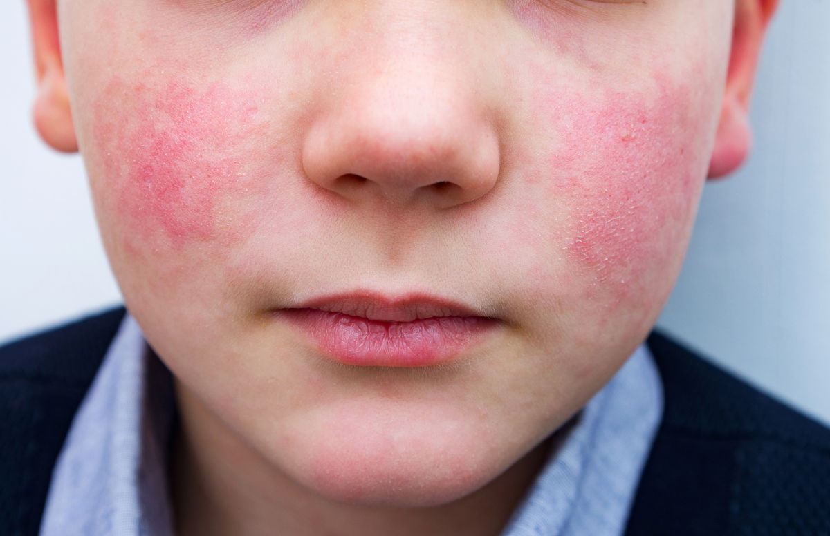 Viral rash called ‘Slap Cheek’ reported in Southeast Idaho