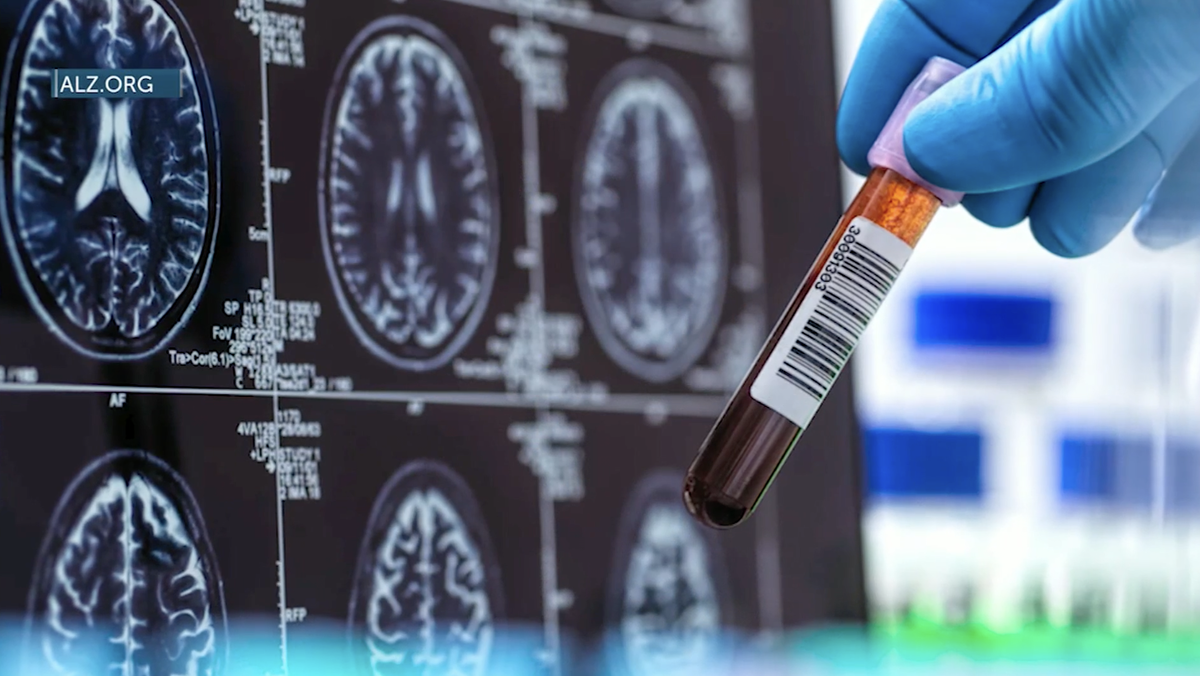 Alzheimer’s Awareness Month: local neurologist highlights early Alzheimer’s symptoms and new diagnostic tools