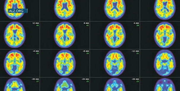 Alzheimer’s Awareness Month: Local neurologist shares promising treatments