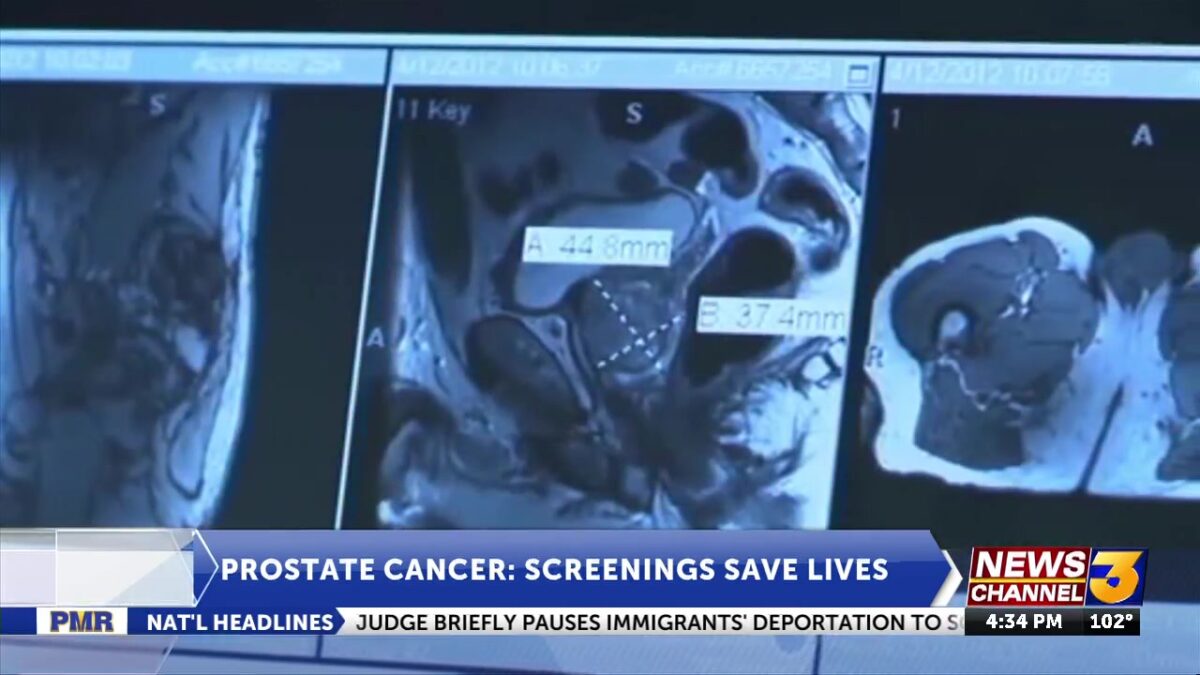 Prostate cancer numbers rise leading doctors to urge early screening that can save lives