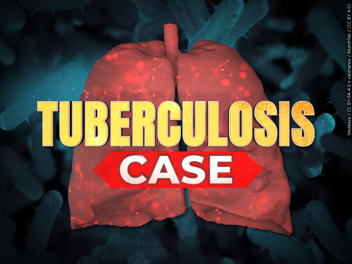 Tuberculosis case reported in Indio