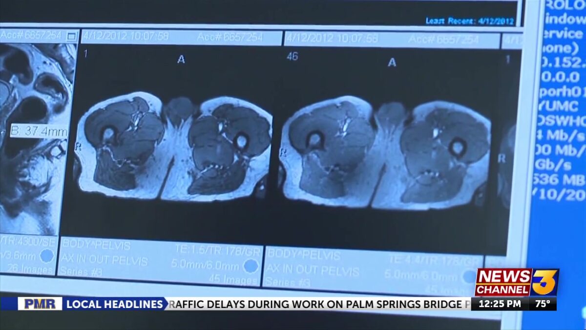 Living Healthy: Prostate artery embolization
