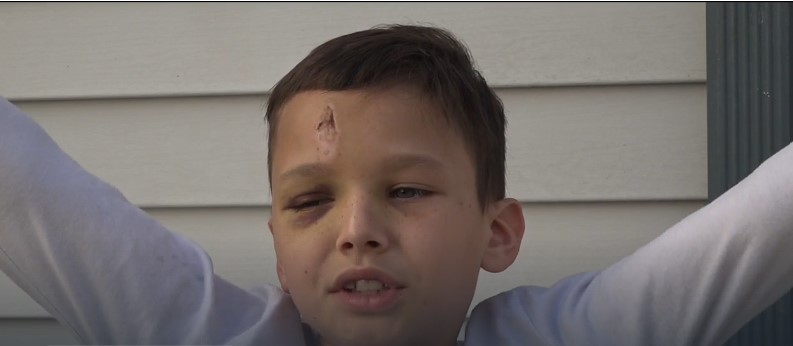 A 9-year-old boy is recovering at home after a serious accident at a playground near his La Mesa home led to multiple fractures and a brain bleed.