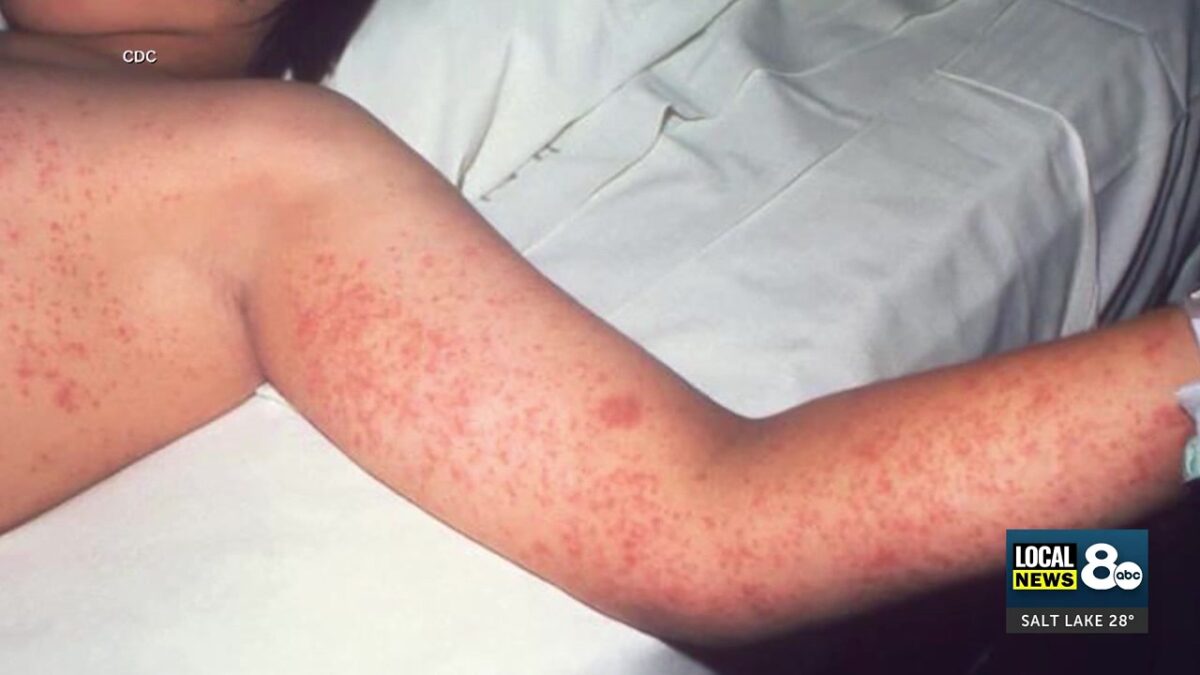Utah Measles surge prompts urgent warnings for Idaho residents