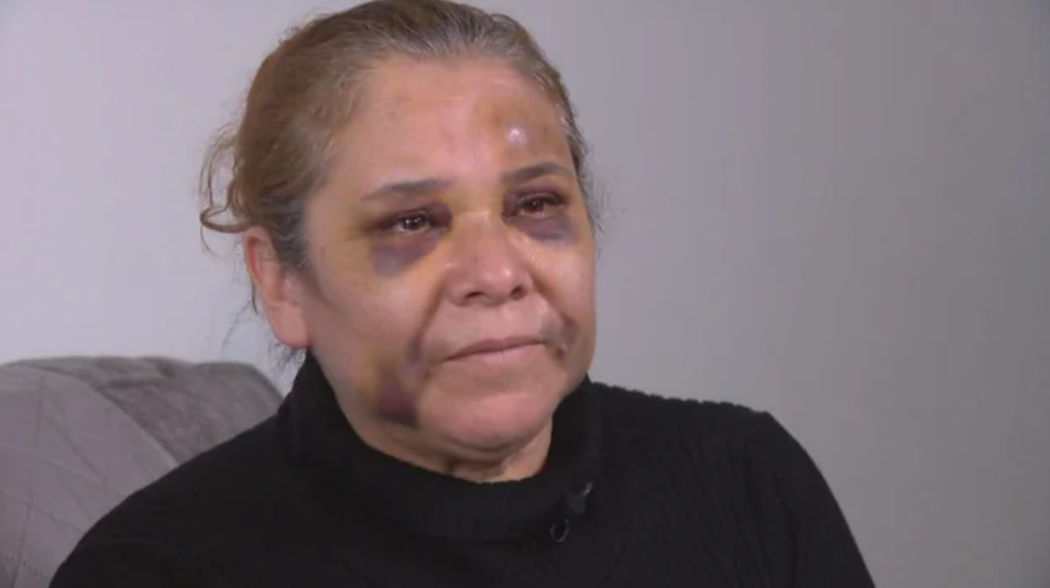 Maria Velezquez was pistol-whipped during an armed robbery at a Family Dollar store in Albany Park.