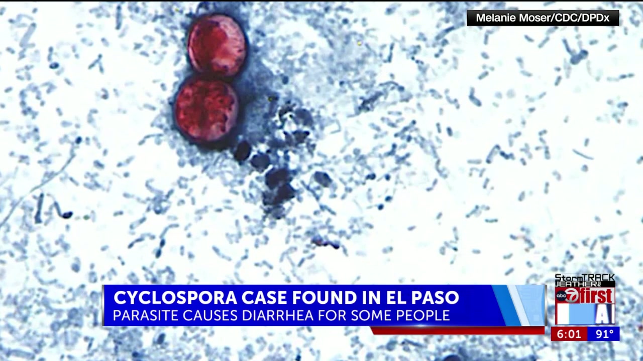 Cyclosporiasis case reported in El Paso; officials say risk is low