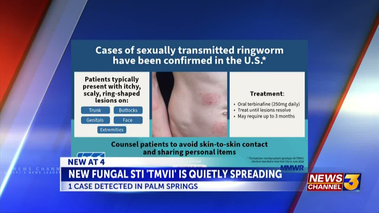 New fungal infection raises concern as cases spread in the U.S.