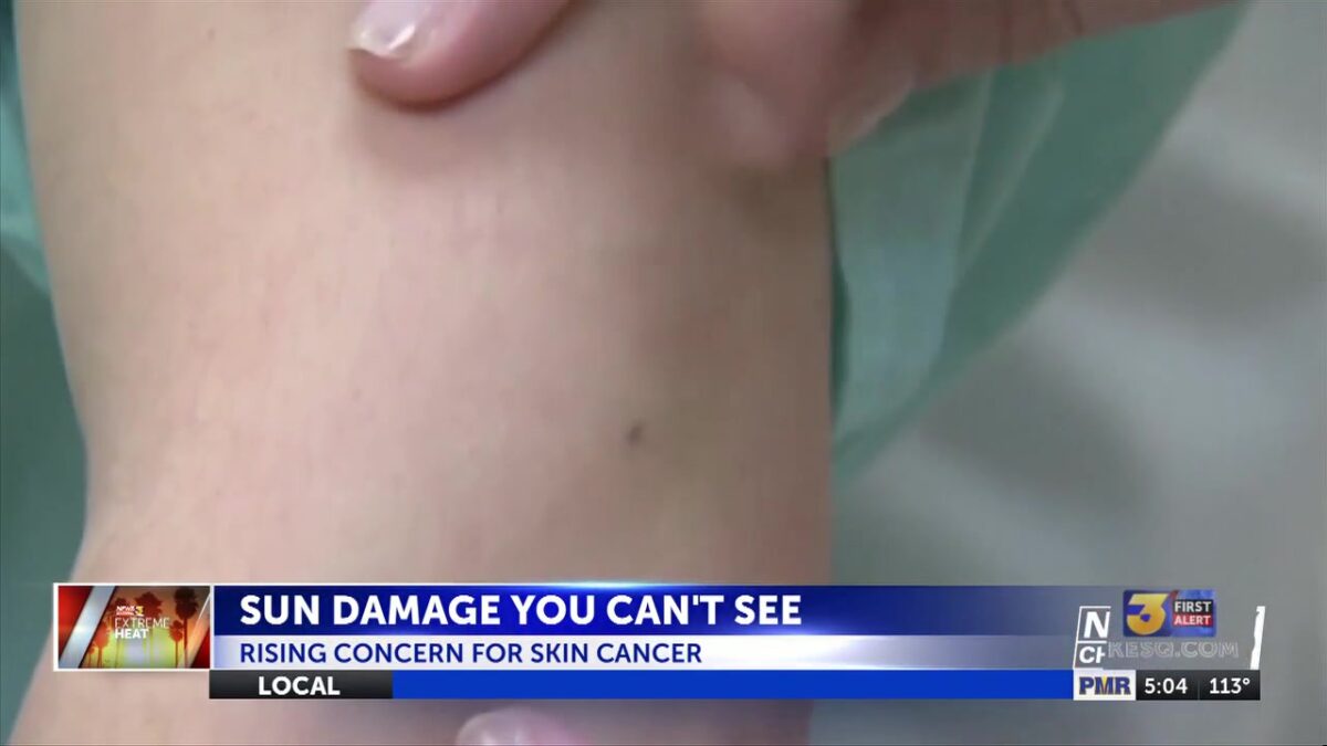 The sun damage you can’t see