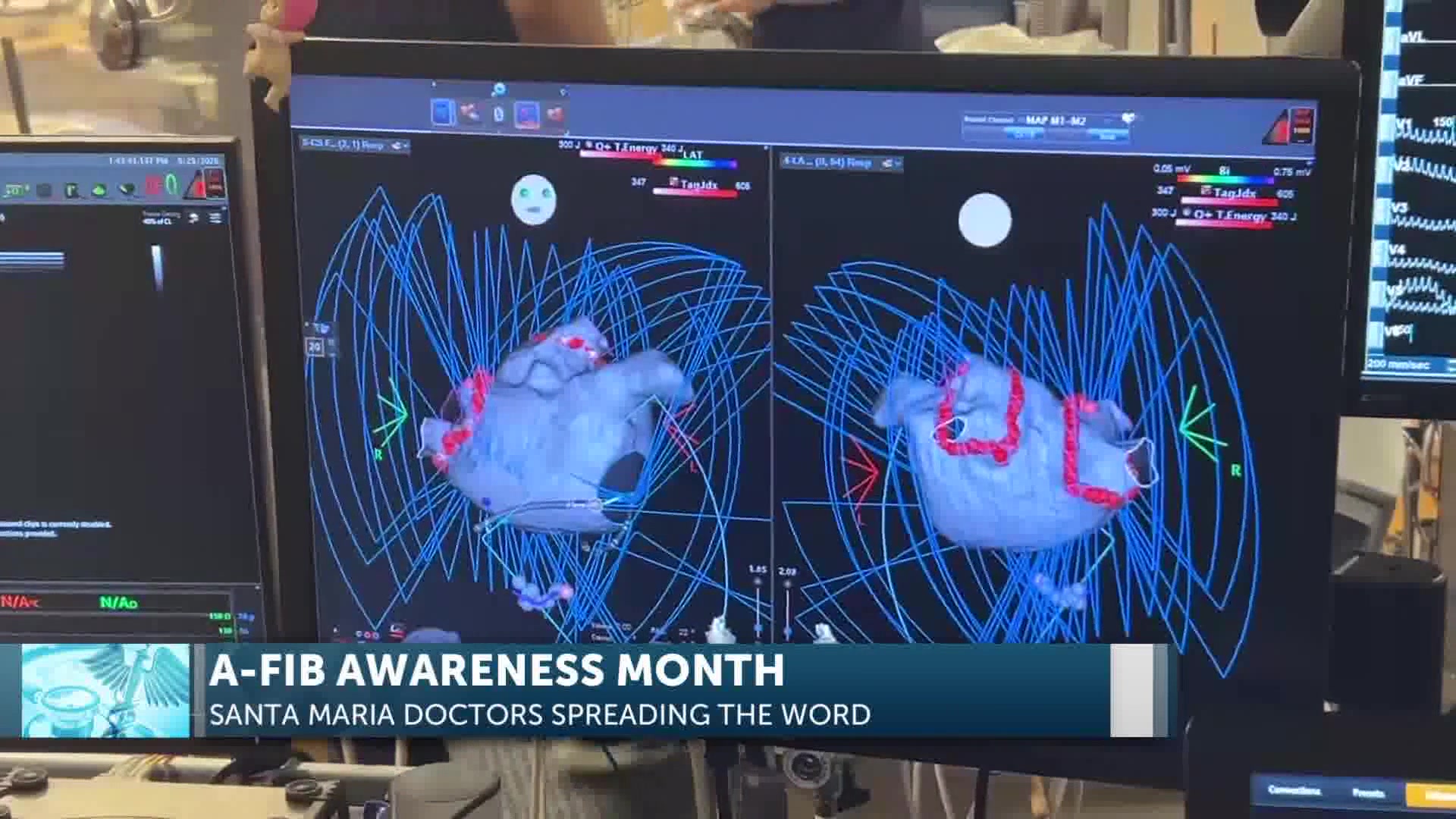Santa Maria Doctors Seeing Rise In Cases During AFib Awareness Month